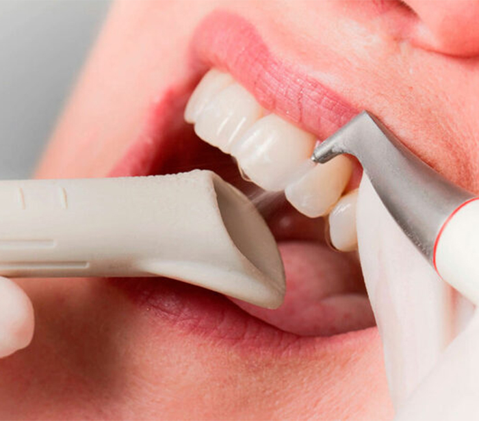 Чистка зубов Air Flow в стоматологии DoctorLAV в Краснодаре