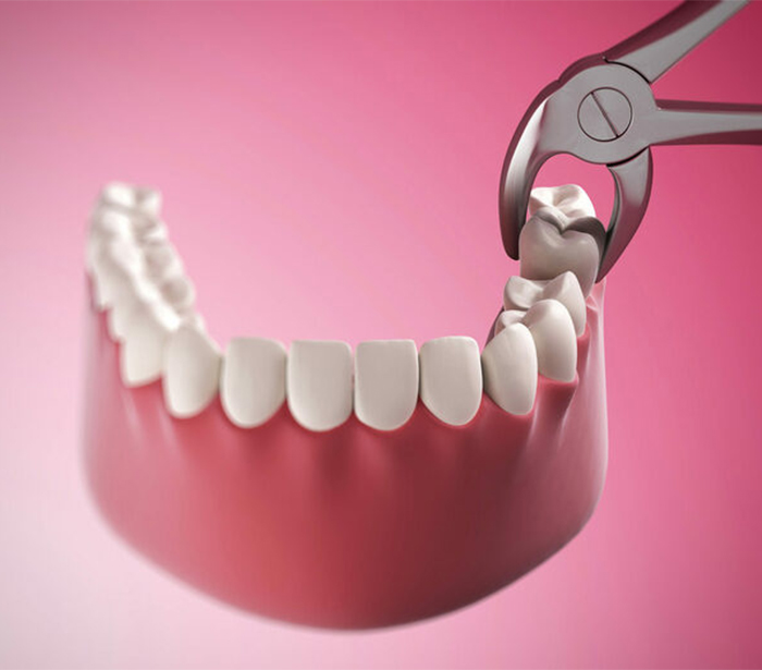 Зуб мудрости удаление по доступной цене операция без боли | Doctor Lav