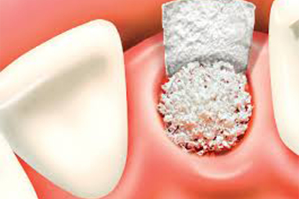 Наращивание кости для имплантации зуба