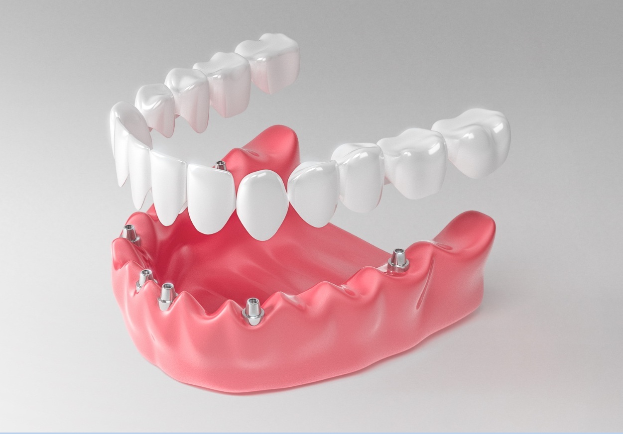 Протезирование зубов на постоянной основе