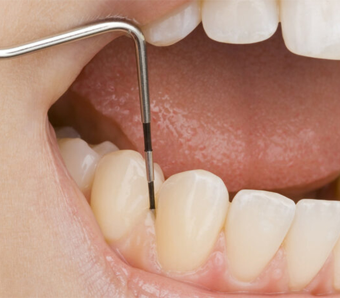 Лечение пародонтита в Краснодаре в стоматологии DoctorLAV