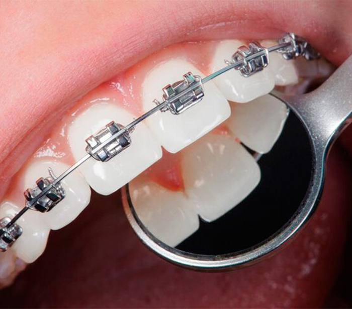 Ортодонтическое лечение зубов в стоматологии в Краснодаре